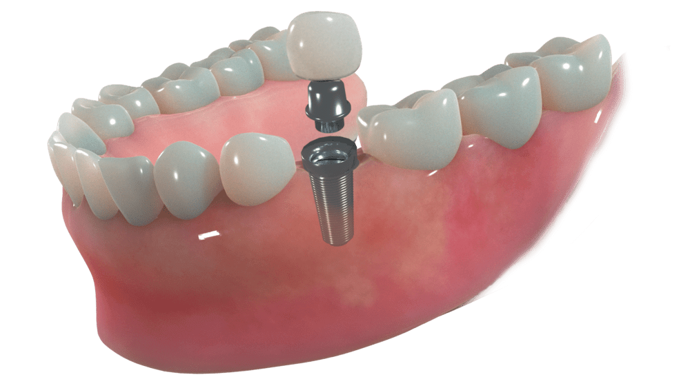 Medical diagram of a dental implant